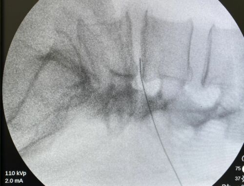 Discolisis con Ozono: Una Alternativa Eficaz y Mínimamente Invasiva para la Hernia Discal